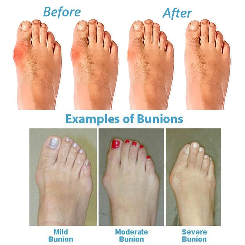 Women's Corrective Hallux Sandals | Orthopedic Wide Toe Box